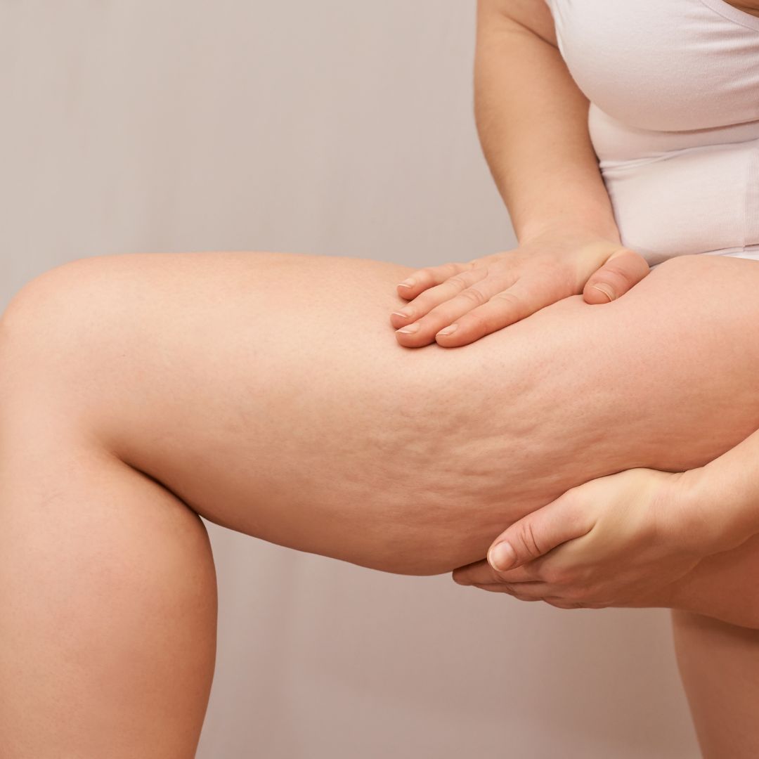 Woman's thigh with cellulite