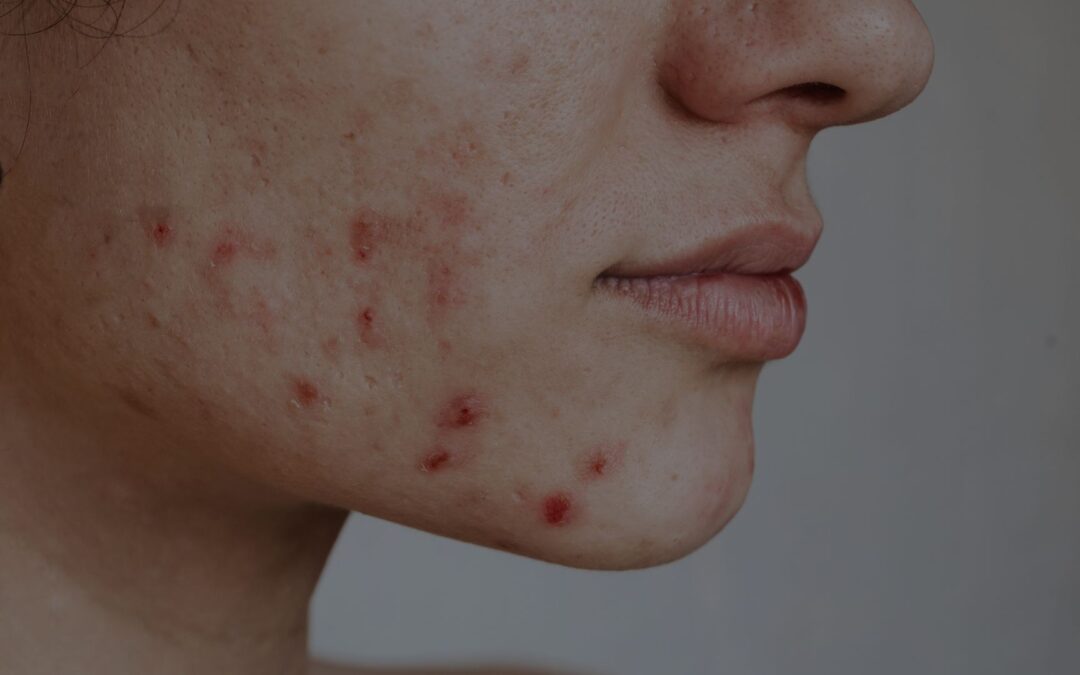 Say Goodbye to Acne: How Red Light Therapy Helps Clear Up Your Complexion