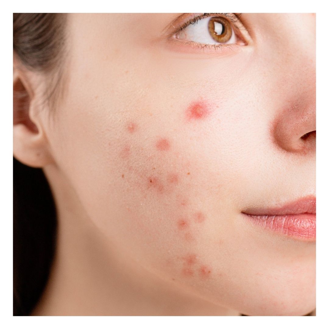 inflamed acne