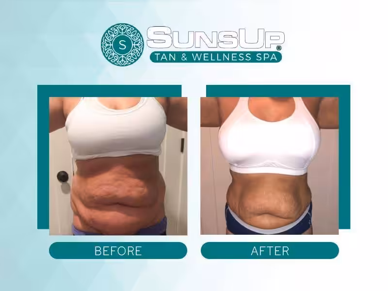 SUNSUP spa before and after comparison showis woman's torso in white sports bra with BEFORE and AFTER labels.