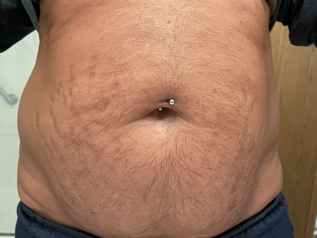Close-up of abdomen with navel piercing and stretch marks