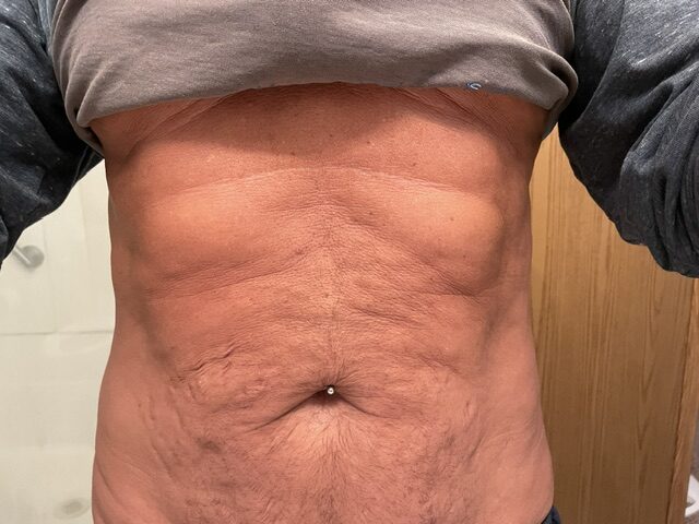 Loose abdominal skin after weight loss